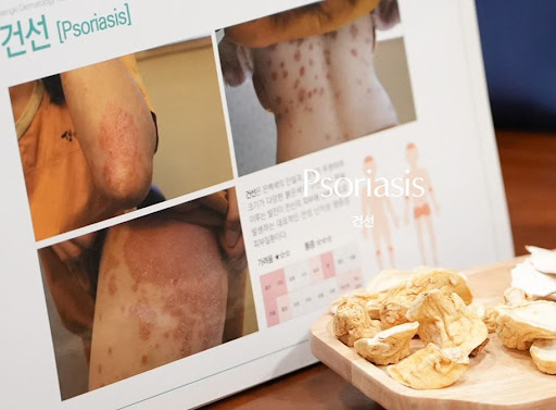 생기한의원 건선 정보, 두피 부위 증상 관찰 시 확인 사항
